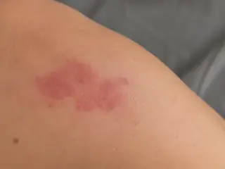 Tache rouge d'angiome plan sur peau claire de l'épaule.