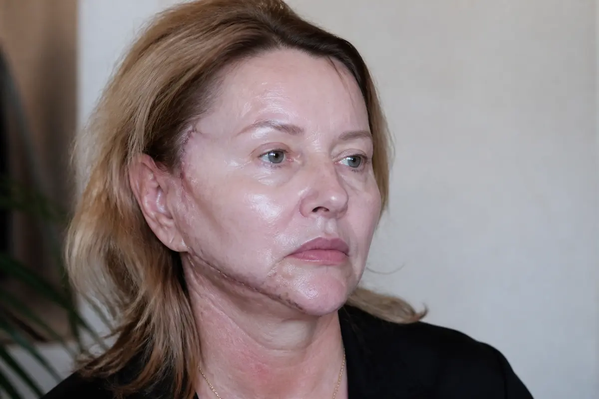 Femme mature montrant un lifting du visage raté avec des cicatrices visibles
