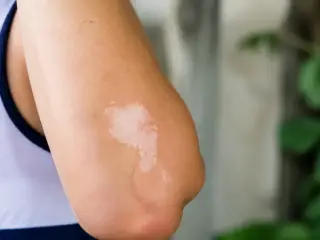 Bras avec une tache blanche sur la peau, entouré de nature floue.