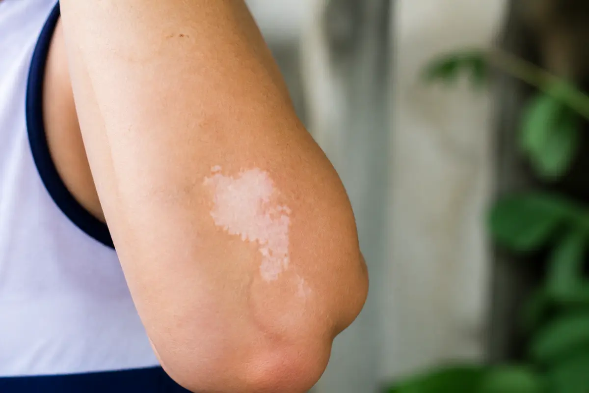 Bras avec une tache blanche sur la peau, entouré de nature floue.